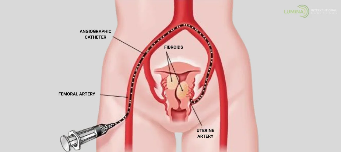 Medical illustration showing catheter path for uterine fibroid embolization.