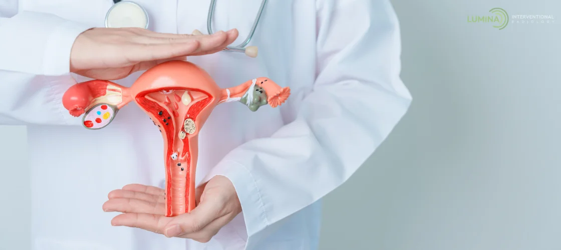 Doctor holding anatomical model of female reproductive system with fibroids.